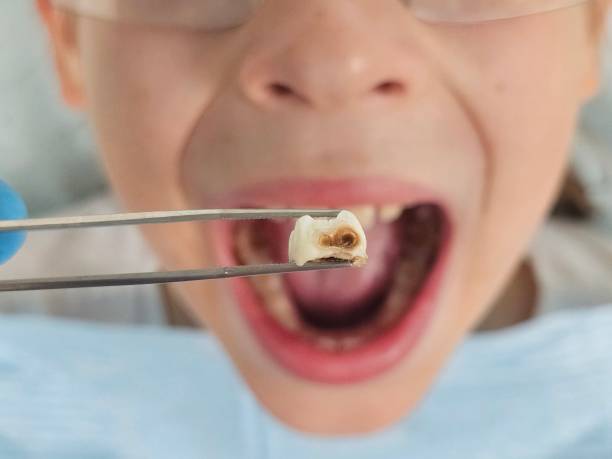 Best Urgent Care for Lost Fillings or Crowns in Port Labelle, FL